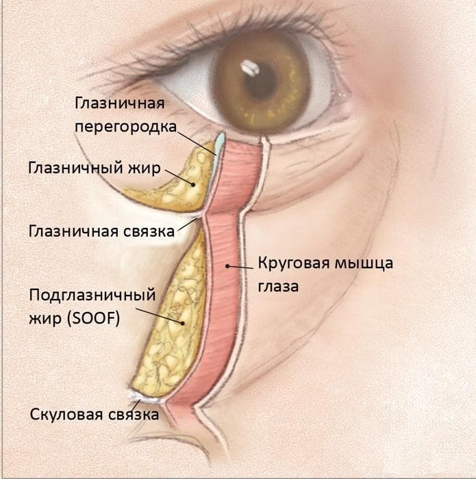 Грыжа века и скуловая грыжа