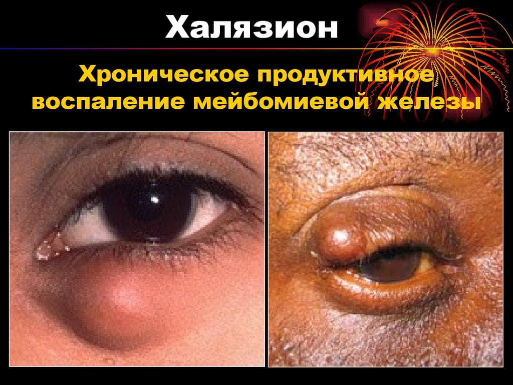 Халязион