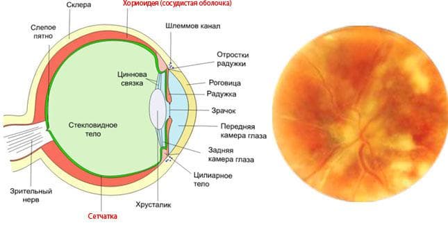 xorioretinit