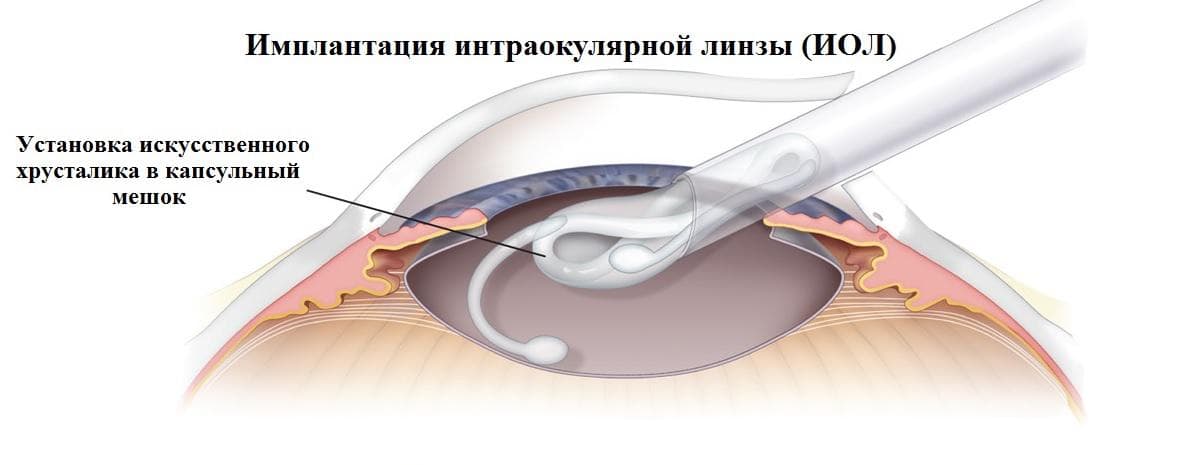implantaciya-xrustalika