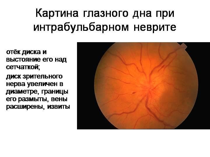 intrabulbarnyj-nevrit-zritelnogo-nerva