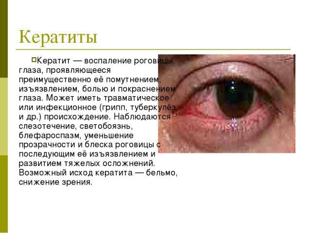 Кератит
