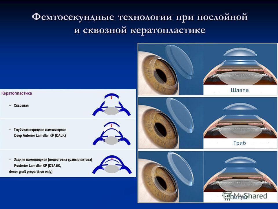 Кератопластика