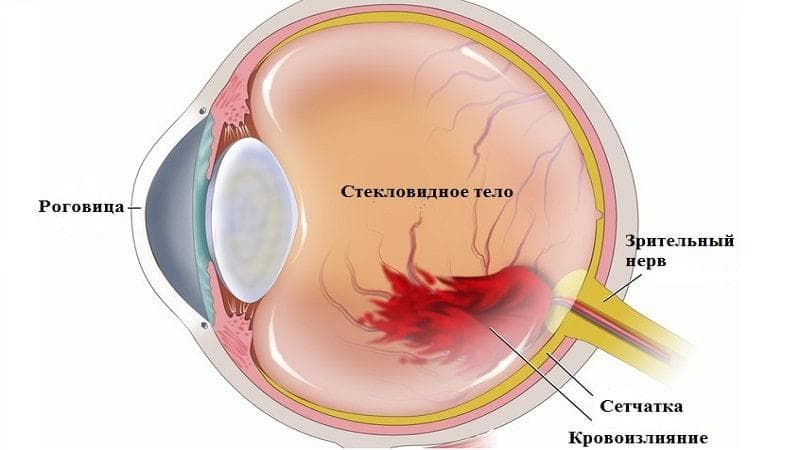 Кровоизлияние в сетчатку глаза