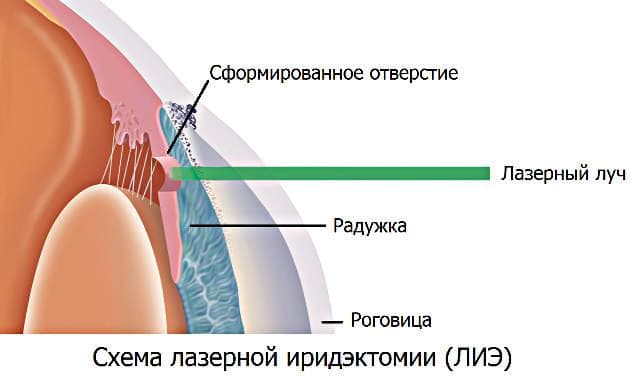 Лазерная иридэктомия