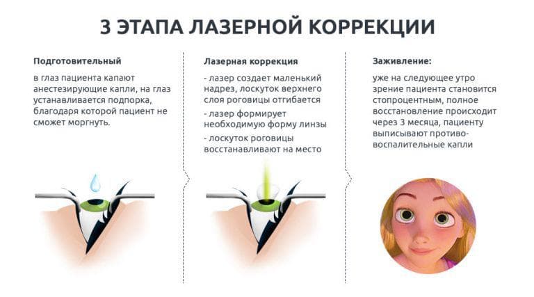 Лазерная коррекция зрения