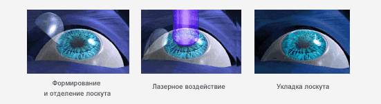 Лазерная коррекция зрения при близорукости