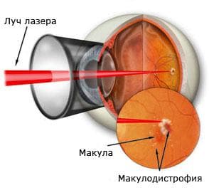 Лечение макулодистрофии лазером
