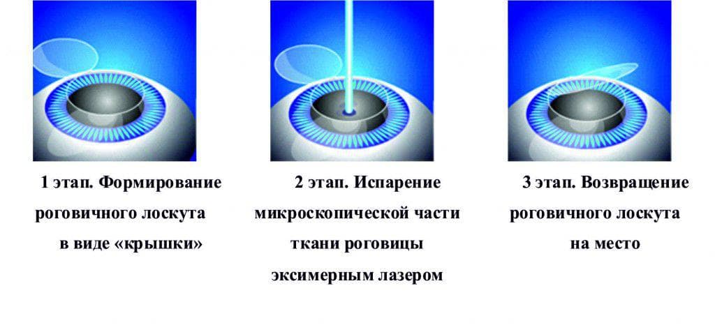 Методика Ласик