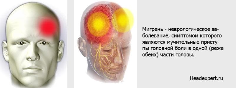 Мигрень