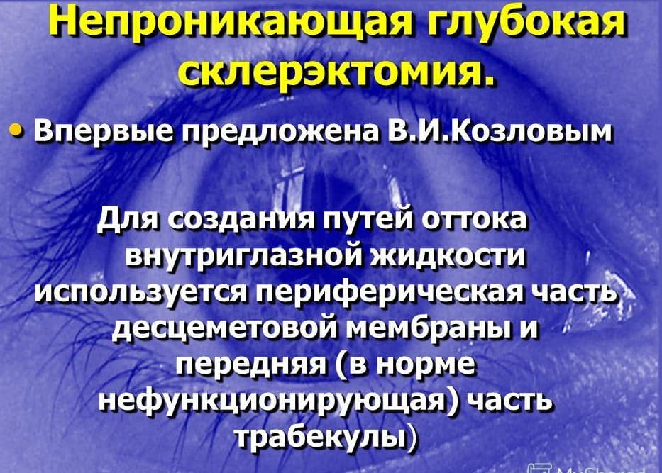 Непроникающая глубокая склерэктомия