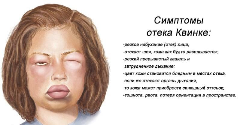 otek-kvinke