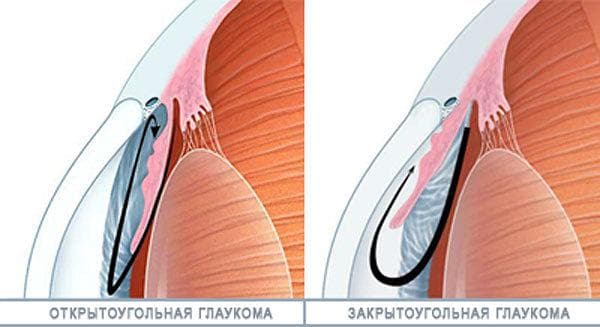 Открытоугольная глаукома
