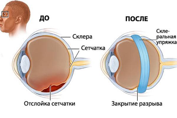 otsloenie-ili-degeneratsiya-setchatki4