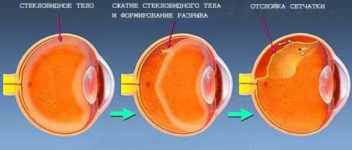 Отслойка сетчатки глаза, симптомы, причины, диагностика 5