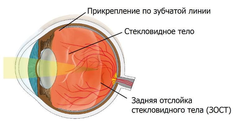 otslojka-v-steklovidnom-tele