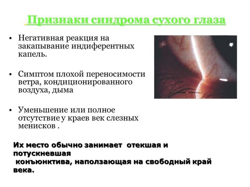 Синдром сухого глаза