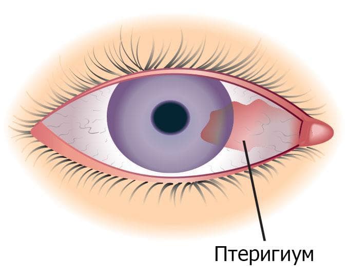 pterigium