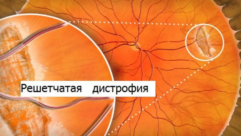 reshetchataya-distrofiya-setchatki