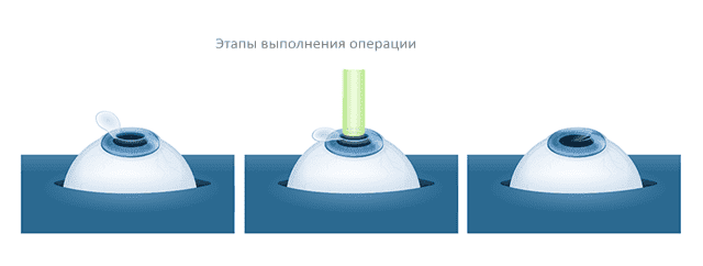 SUPER LASIK