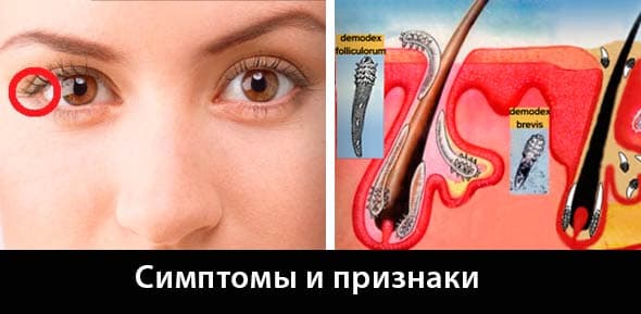 Симптомы демодекоза глаз