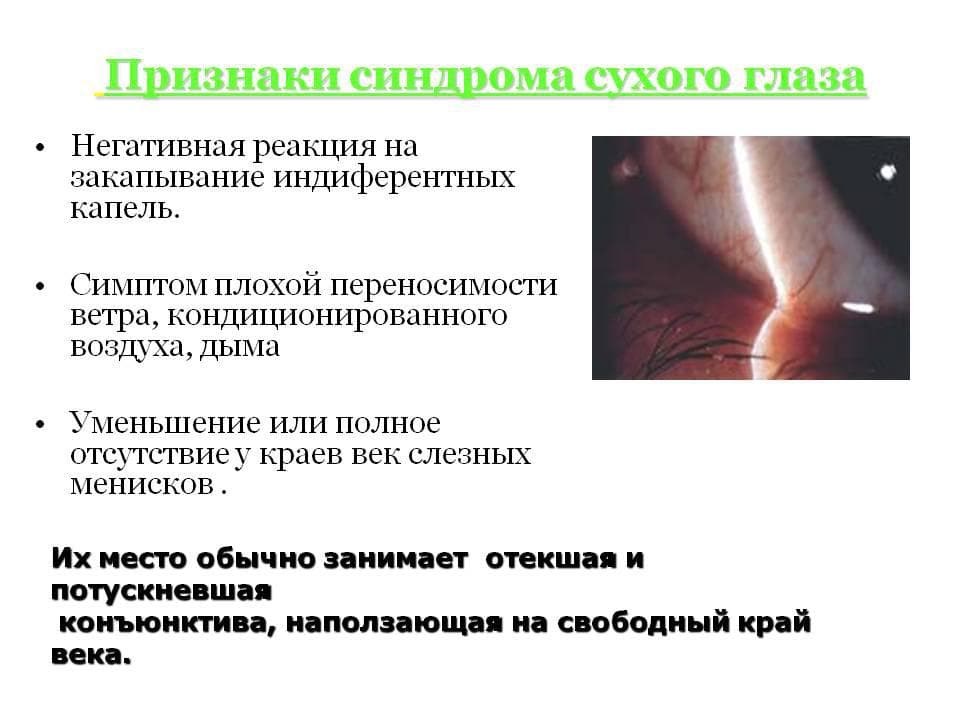 Синдром «сухого» глаза