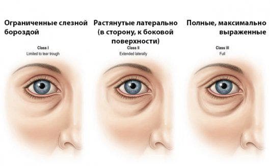 степени грыжи под глазами