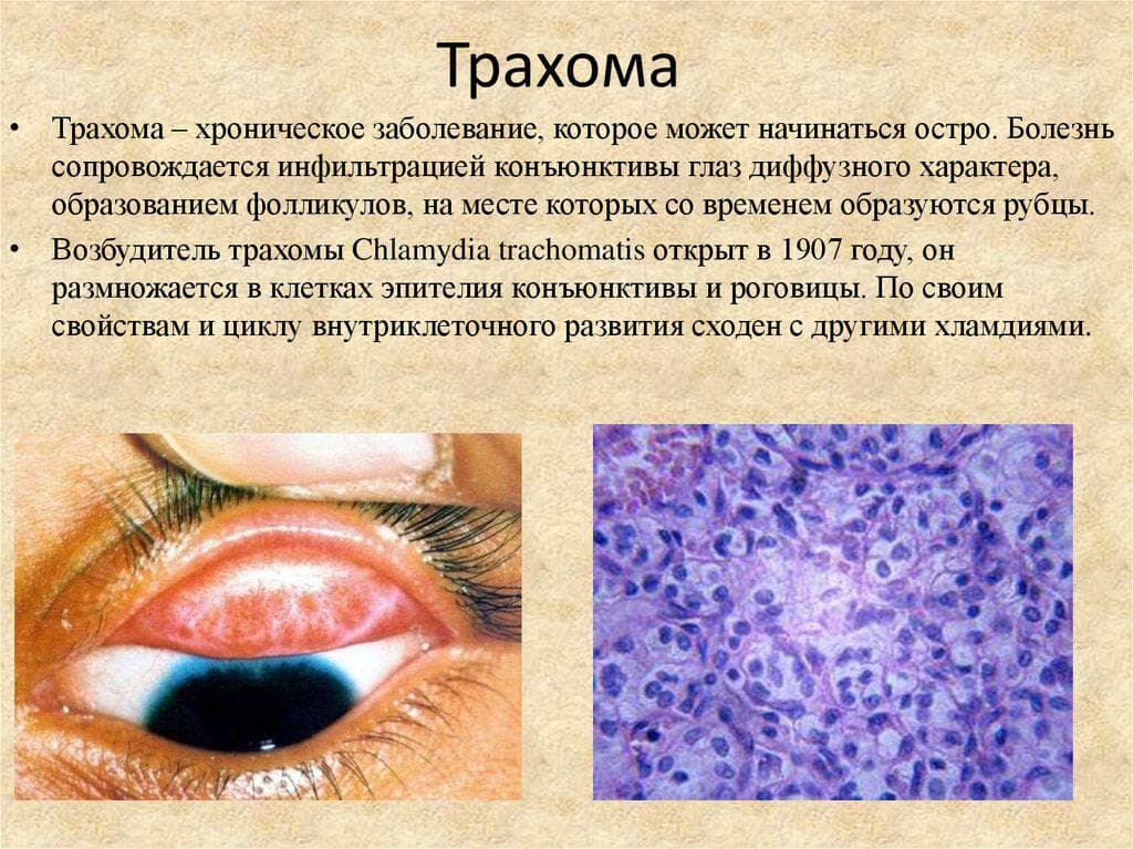 traxoma