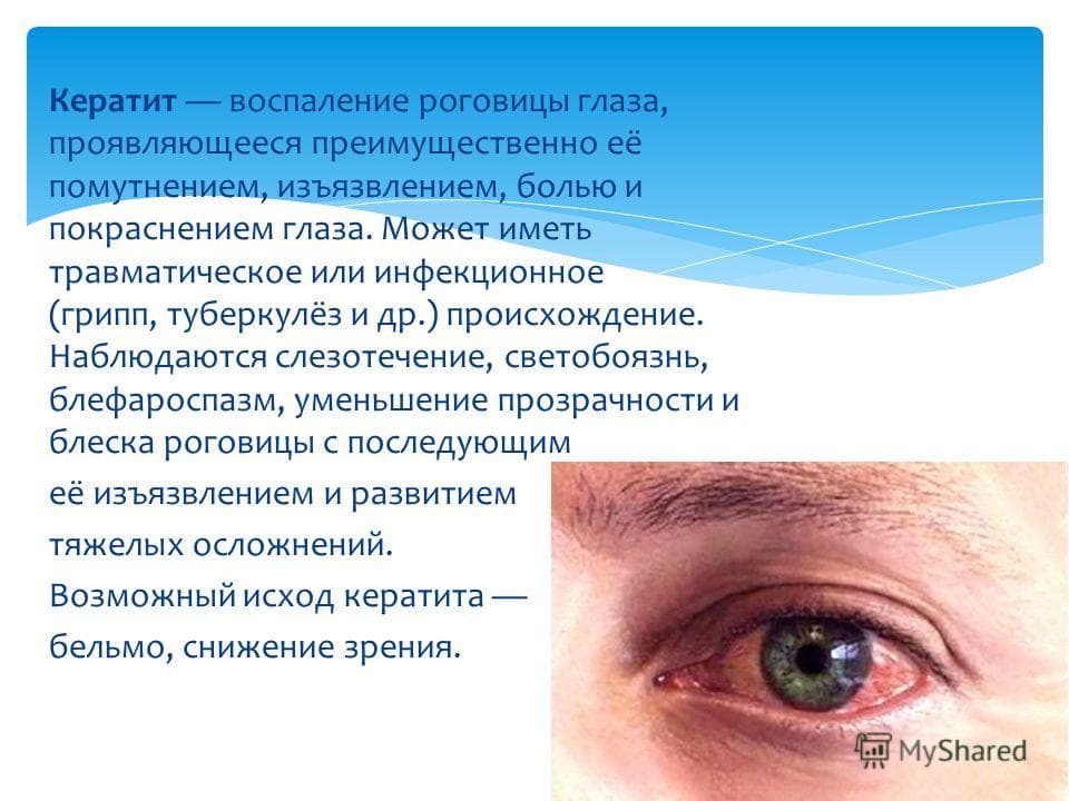 Воспаление роговицы
