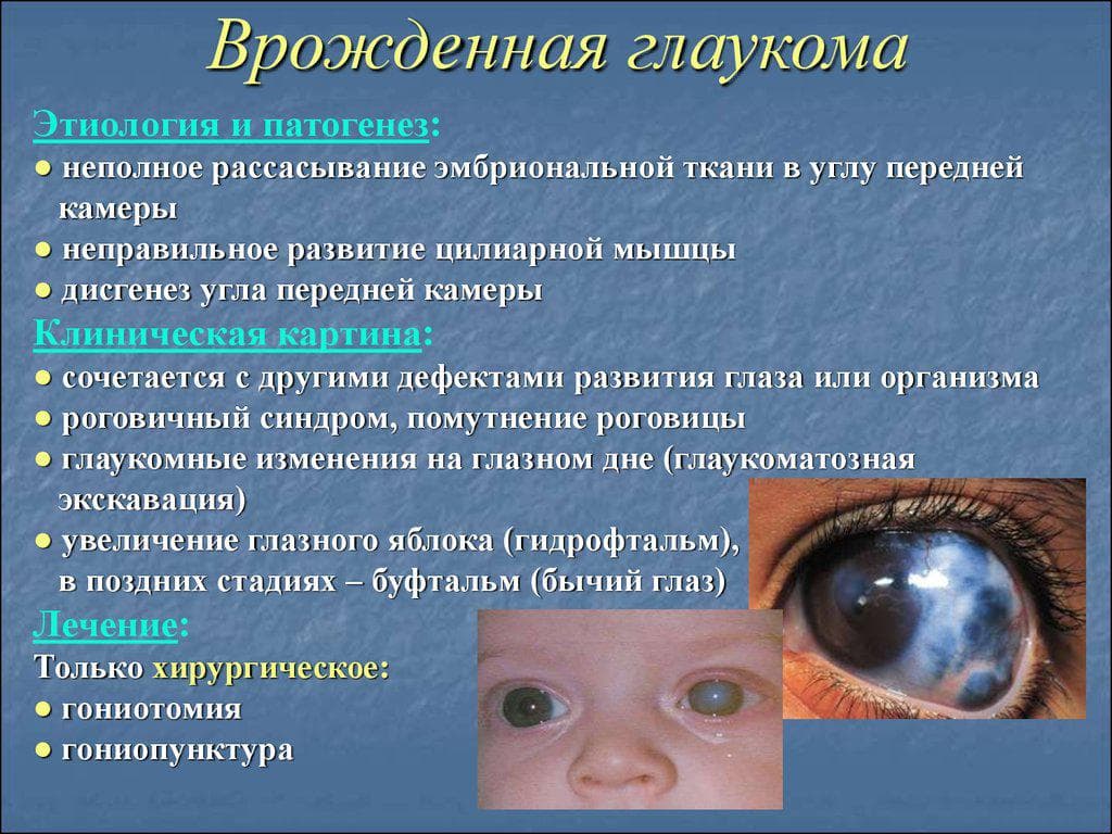 vrozhdennaya-glaukoma