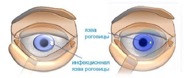 yazva-rogovicy
