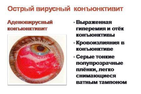 как лечить конъюнктивит у взрослых, конъюнктивит лечение у взрослых, гнойный конъюнктивит лечение у взрослых, конъюнктивит у взрослых, конъюнктивит у взрослых симптомы и лечение, конъюнктивит как вылечить быстро у взрослого,