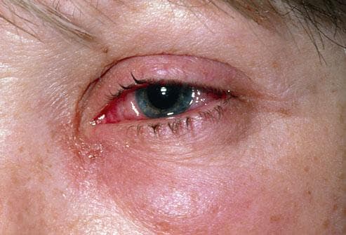 allergiya-na-glazax