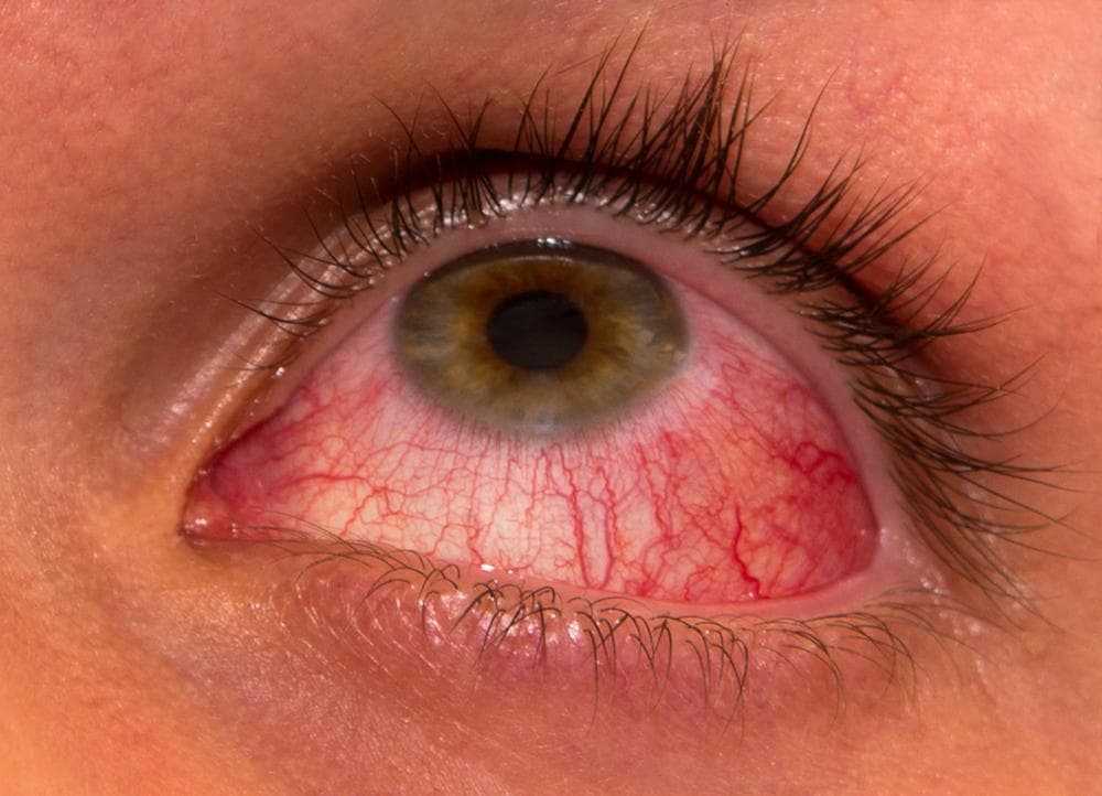 allergkonyunktivit1