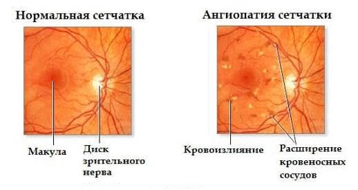 angiopatija-setchatki-simptomy