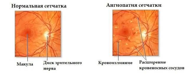 ангиопатия сетчатки глаза