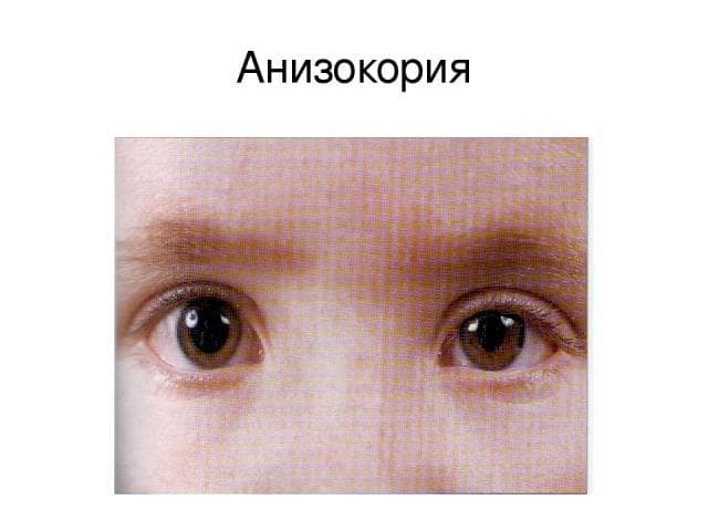 anizokoriya
