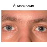 анизокория причины