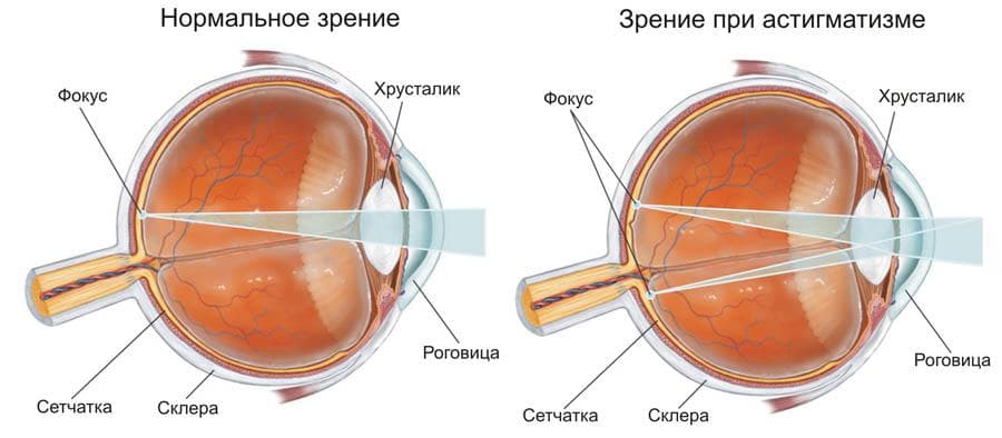 астигматизм