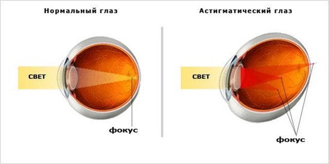 астигматизм