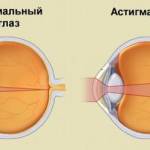 астигматизм симптомы