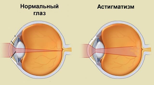 астигматизм у детей