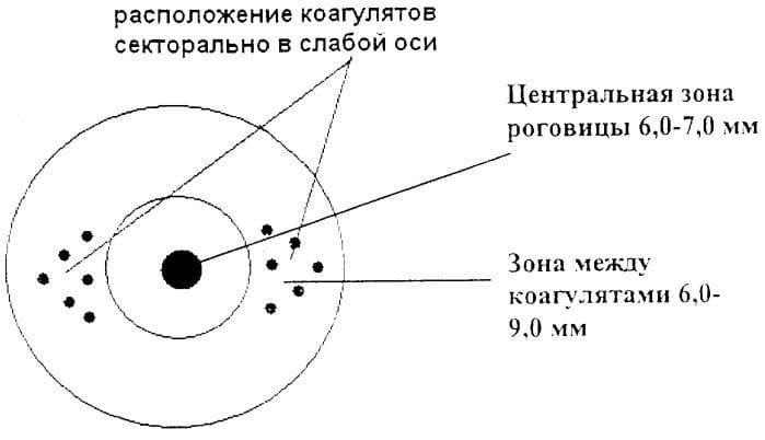 Как лечить астигматизм у детей