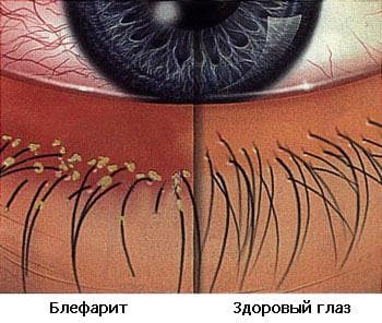 blefarit