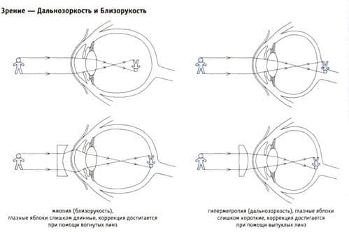 близорукость и дальнозоркость отличия