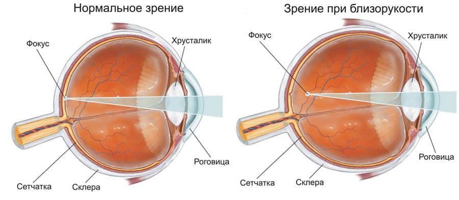 близорукость и нормальное зрение