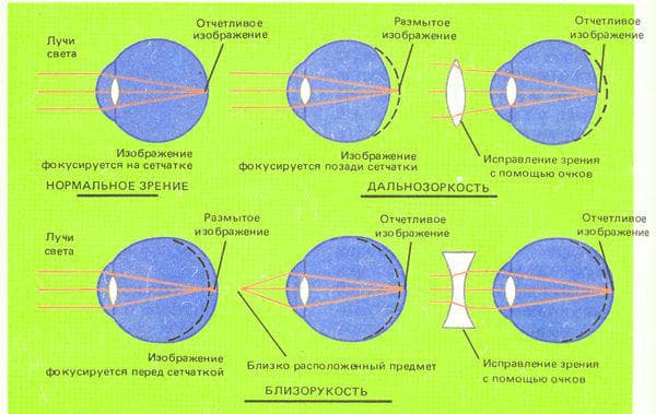 регулируемые очки для коррекции близорукости и дальнозоркости, очки для близорукости, как подобрать очки для зрения при близорукости, подбор очков при близорукости, что лучше линзы или очки при близорукости, лечение близорукости плюсовыми очками, нужно ли носить очки при близорукости постоянно