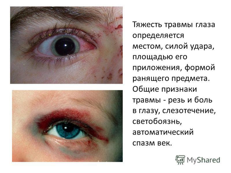 chem-opredelyaetsya-tyazhest-travmy-glaza