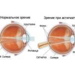 что такое астигматизм глаз у взрослых