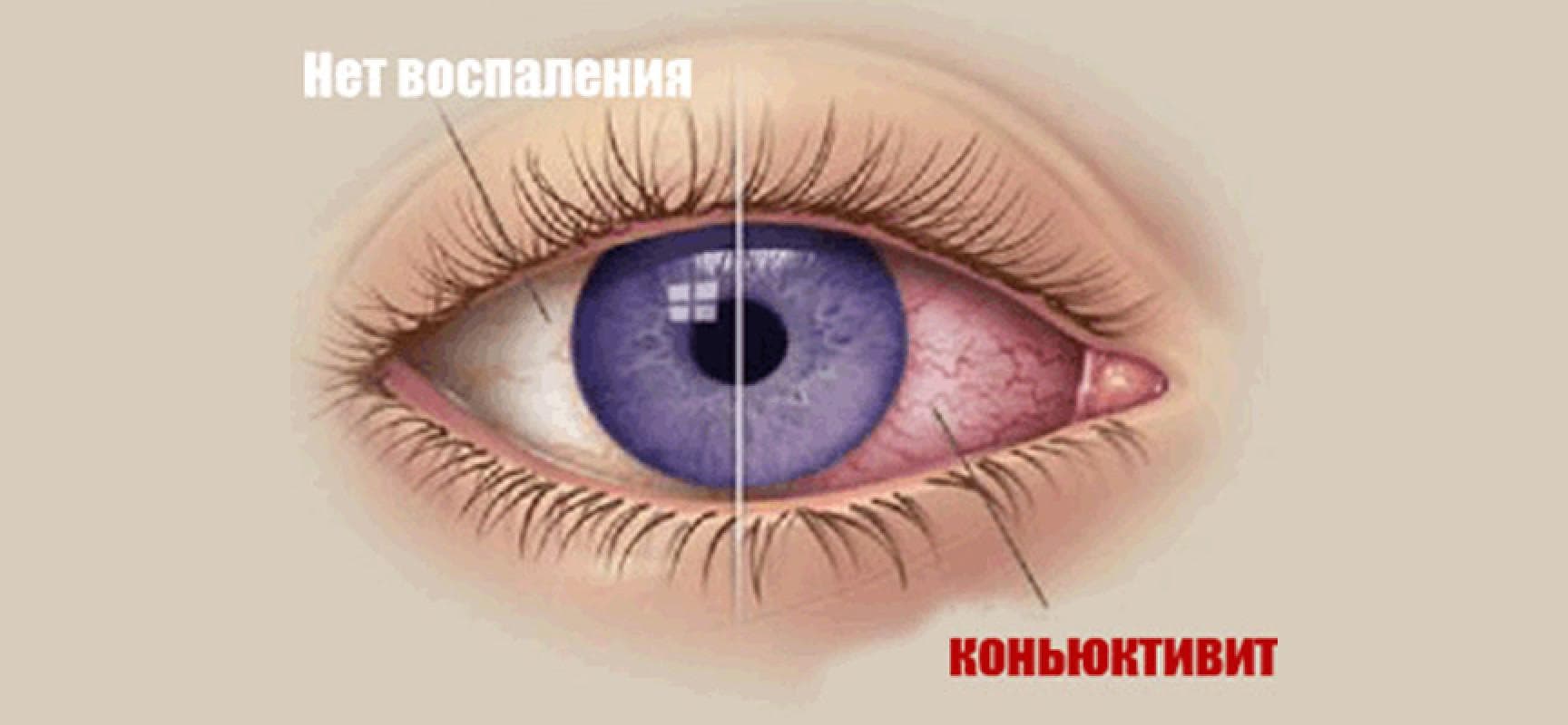 chto-takoe-konyunktivit